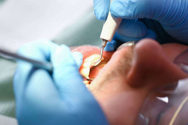 Best Emergency Dental Extractions in Landover Hills, MD