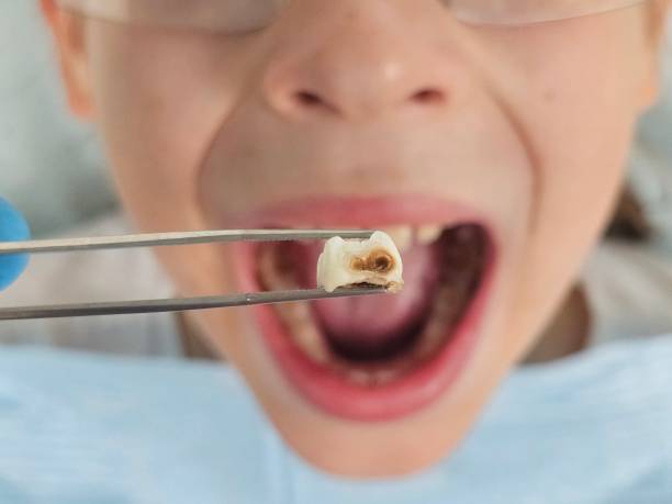 Best Emergency Dental Care for Abscessed Tooth in Landover Hills, MD